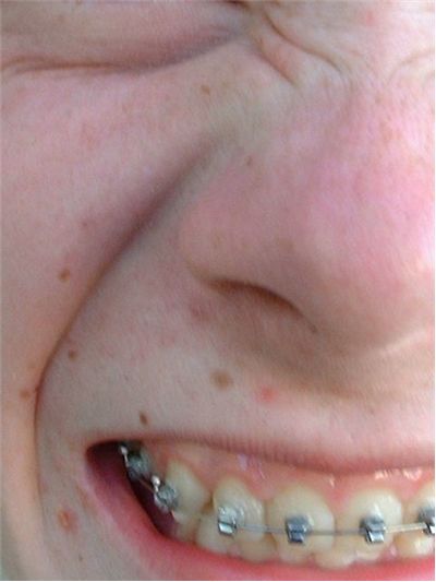 Picture Of Braces