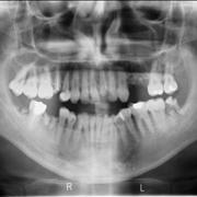 Picture Of Mouth Radiography Broken Tooth
