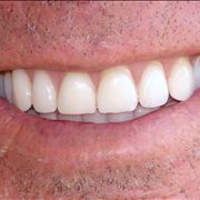 Picture Of New Dentures