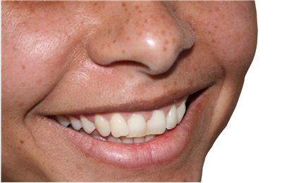 Picture Of Smile Teeth