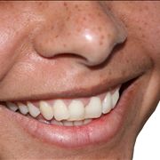 Picture Of Smile Teeth
